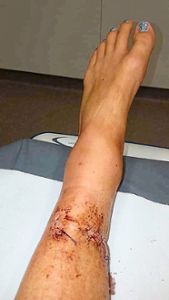 Diese Wunde am Bein hat die Halterin des Kangals bei dem Vorfall erlitten.   Foto: Privat