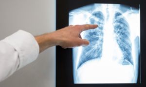 Die Tuberkulose-Bakterien befallen oft die Lunge des Menschen. (Symbolfoto) Foto: dpa
